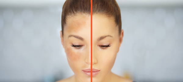 Pigmentation vs Melasma: Understanding the Difference and How to Treat It
